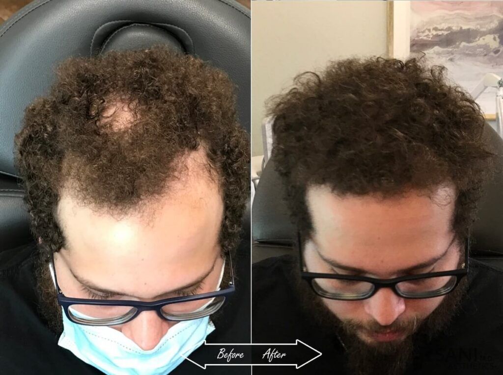 PRP Hair Restoration Before After 14