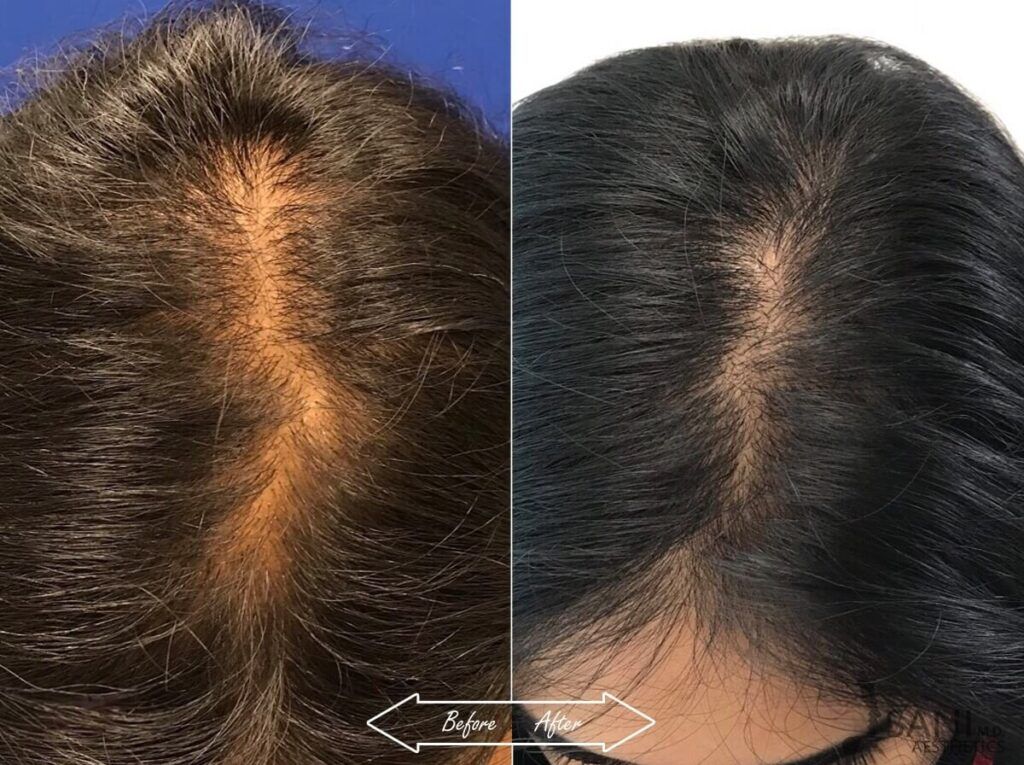 PRP Hair Restoration Before After 15
