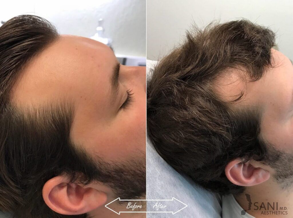 PRP Hair Restoration Before After 16