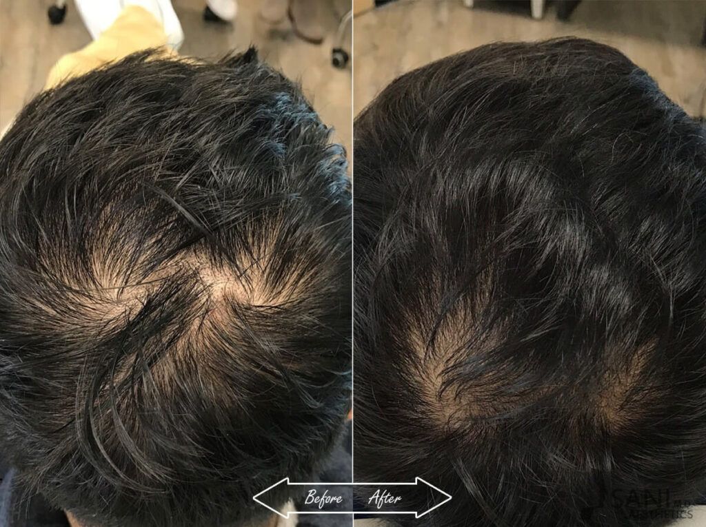 PRP Hair Restoration Before After 17