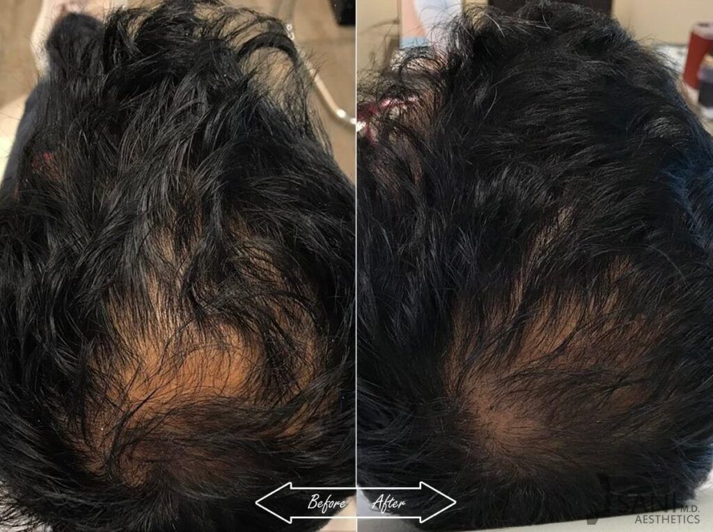 PRP Hair Restoration Before After 18