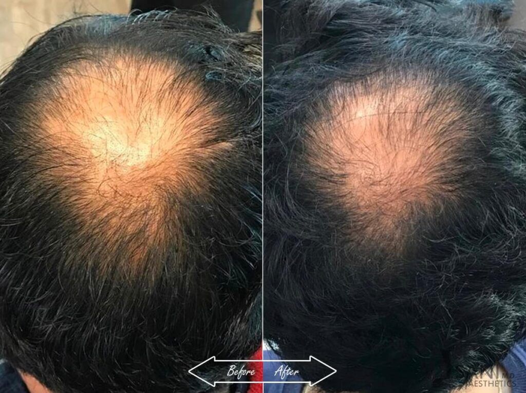PRP Hair Restoration Before After 19