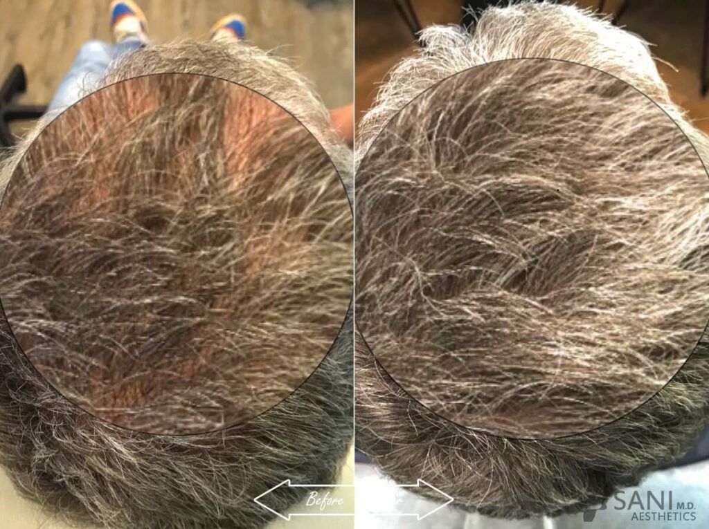 PRP Hair Restoration Before After 2