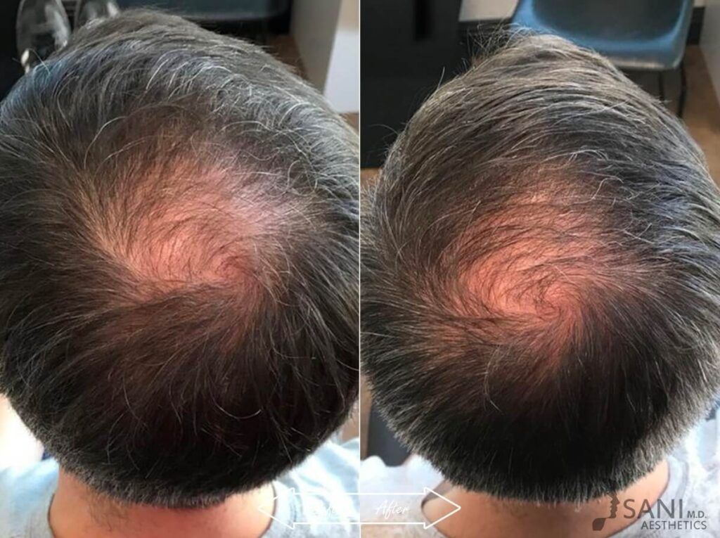 PRP Hair Restoration Before After 21