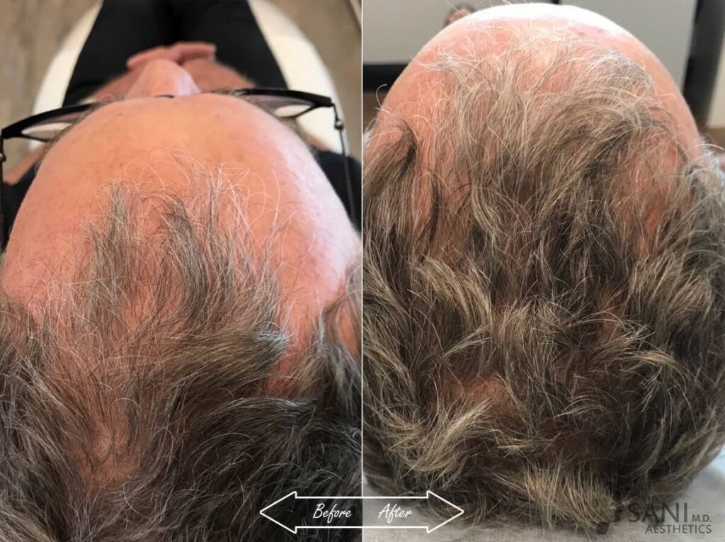 PRP Hair Restoration Before After 3