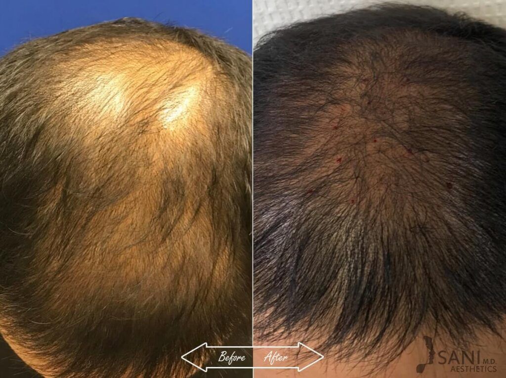 PRP Hair Restoration Before After 4