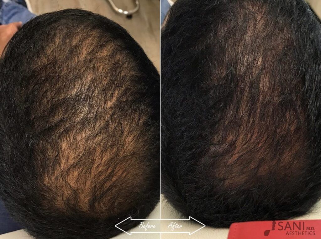 PRP Hair Restoration Before After 5