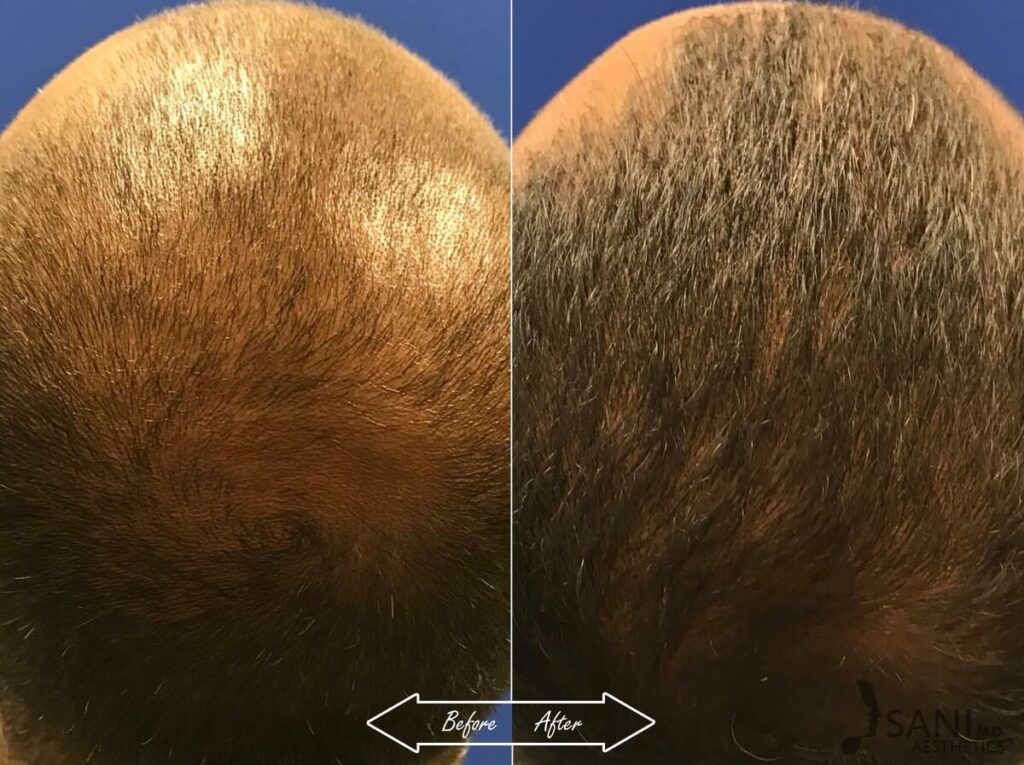 PRP Hair Restoration Before After 6