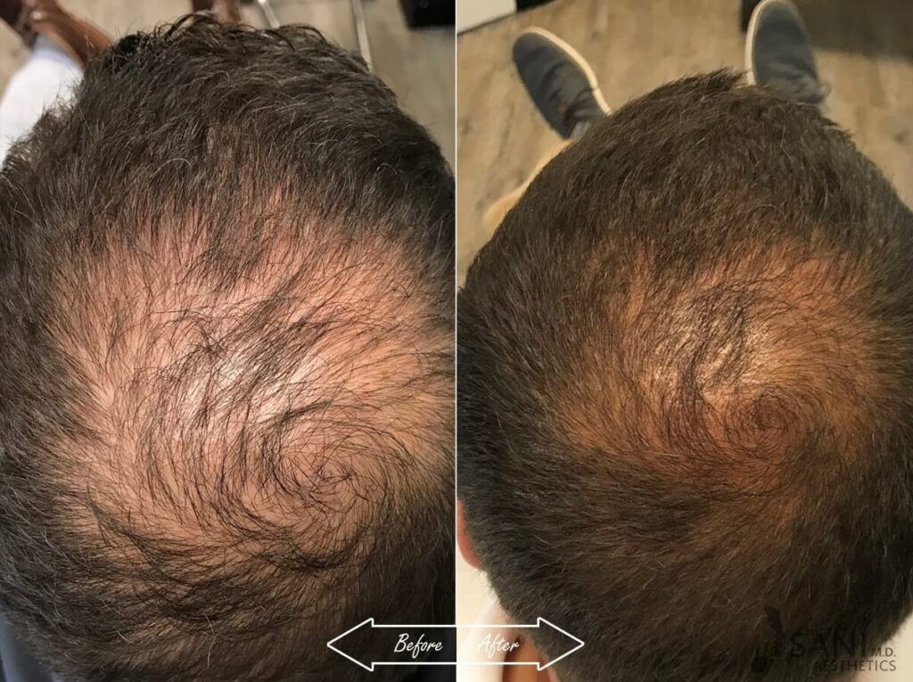 PRP Hair Restoration Before After 7