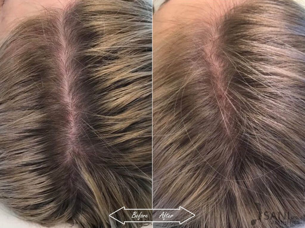 PRP Hair Restoration Before After 8