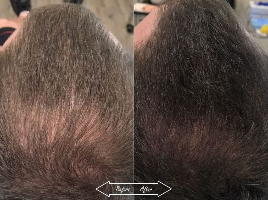 PRP Hair Restoration Before After 9