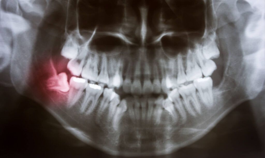 Panoramic x-ray image of teeth. Problem with wisdom tooth