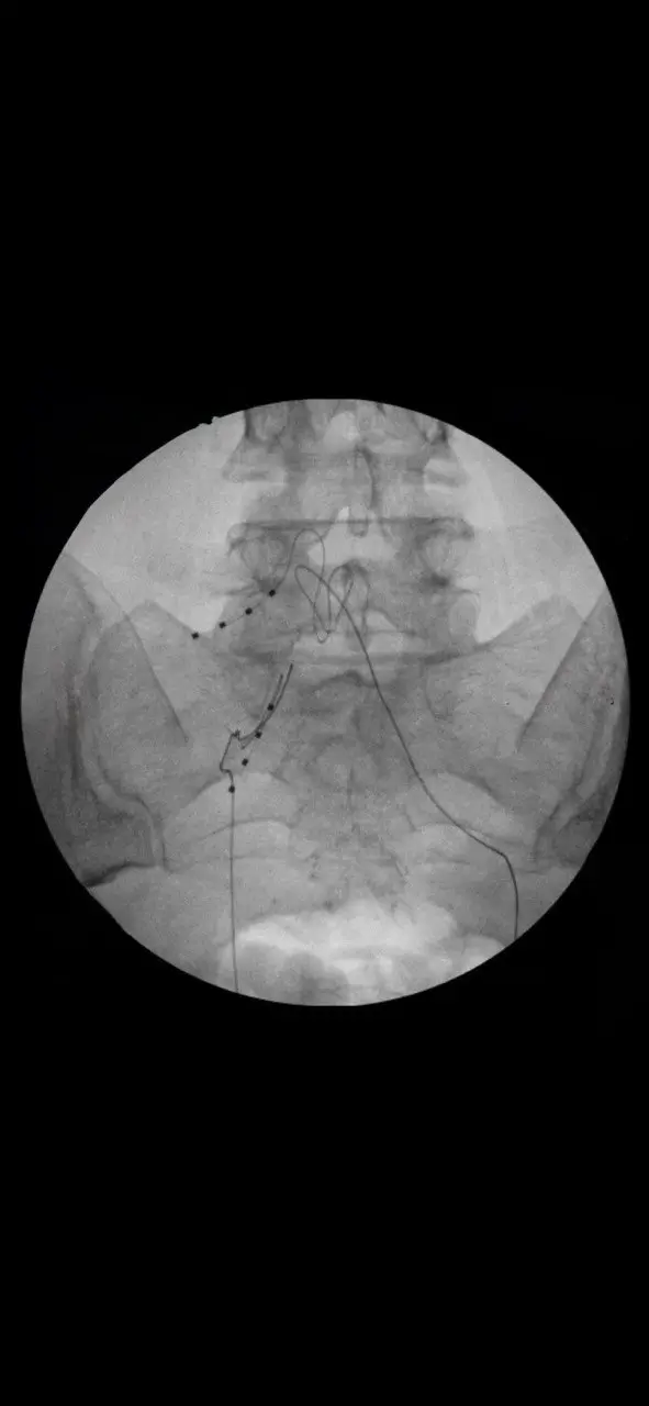 Dorsal Root Ganglion Stimulation