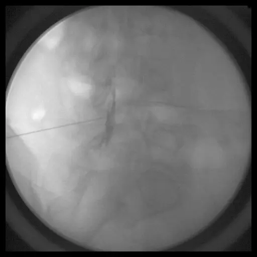 Epidural Injections