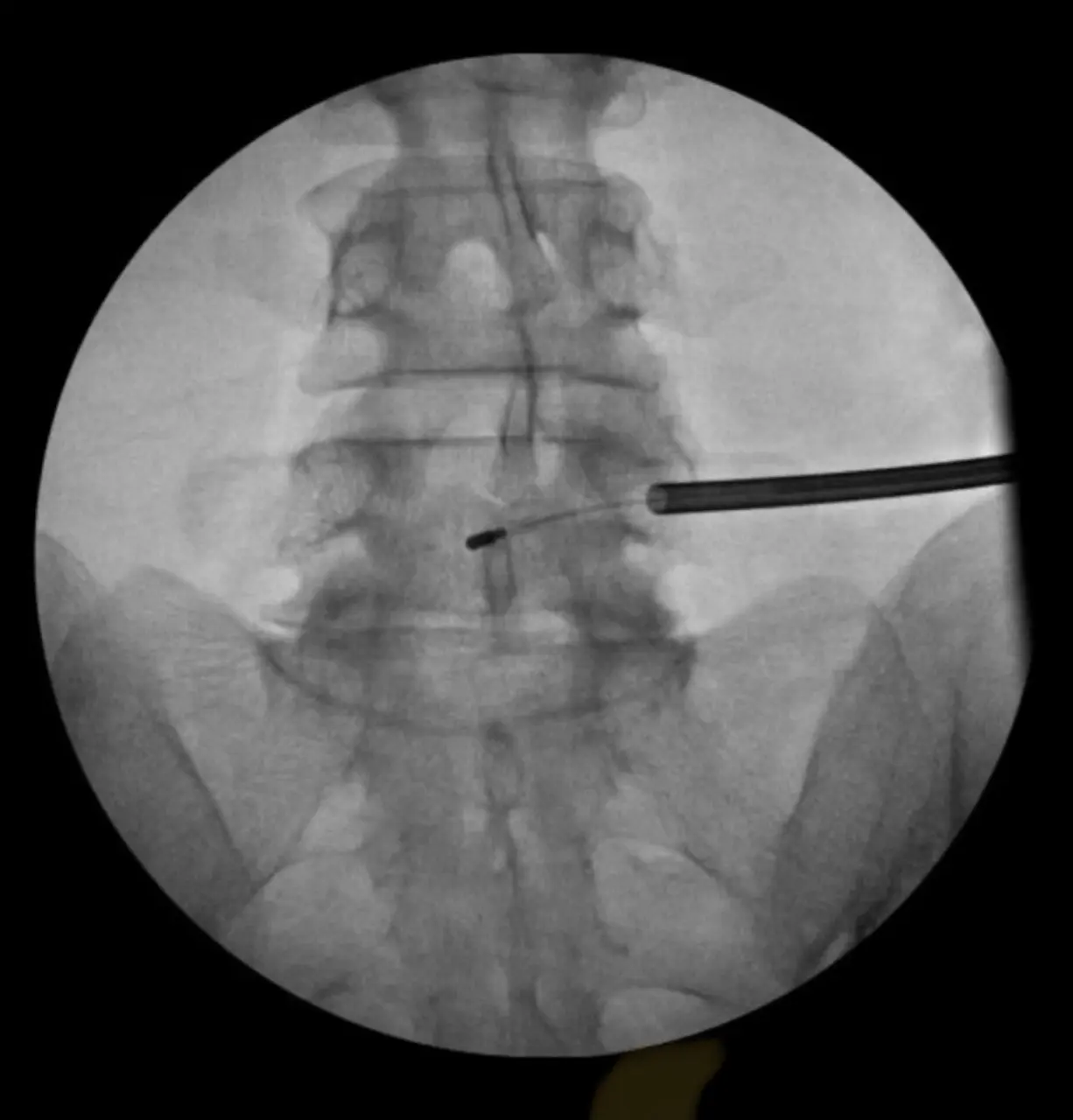 Basivertebral Nerve Ablation-Intracept Procedure