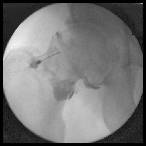 Joint Injection