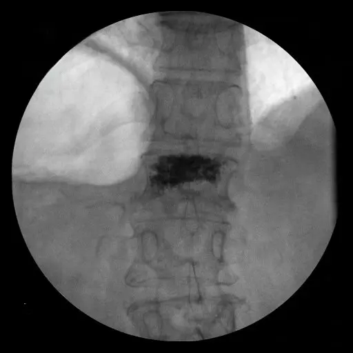 Kyphoplasty