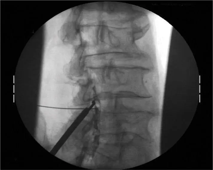 Minimally Invasive Lumbar Decompression (MILD)