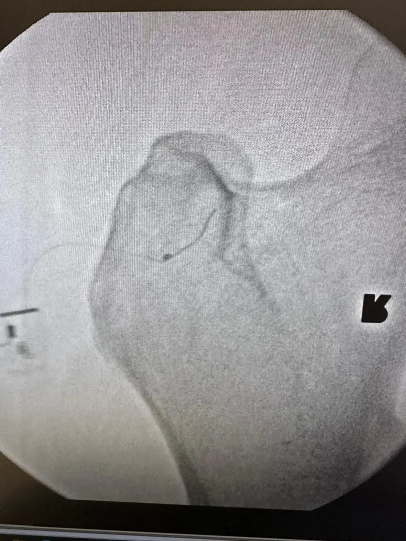 Peripheral Nerve Stimulation