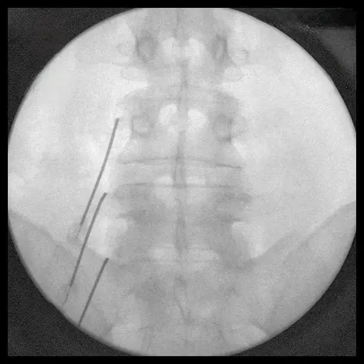Radiofrequency Ablation