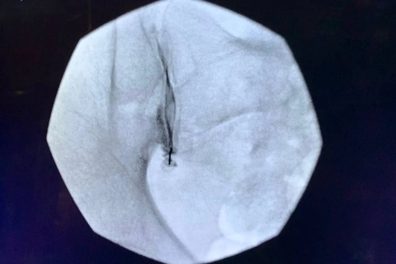 Sacroiliac Joint Injection