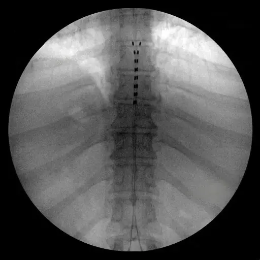 Spinal Cord Stimulation