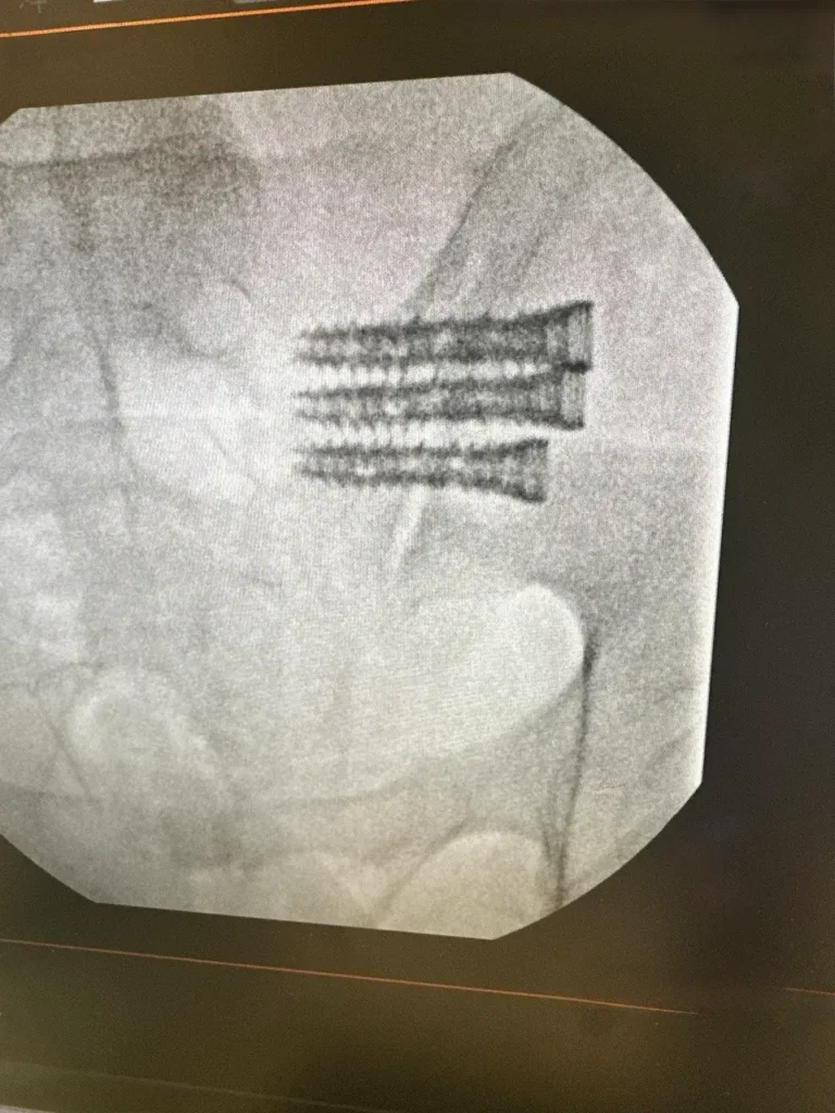 Sacroiliac Joint Fusion