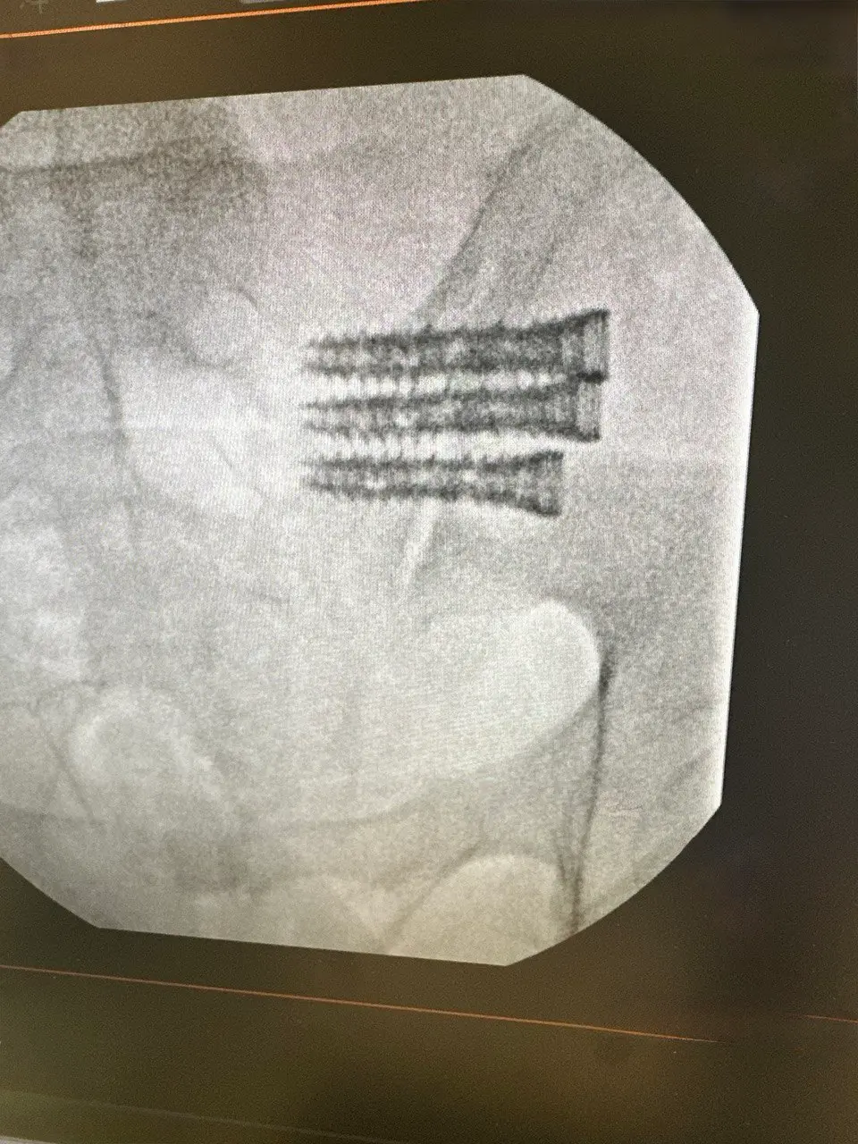 Sacroiliac Joint Fusion