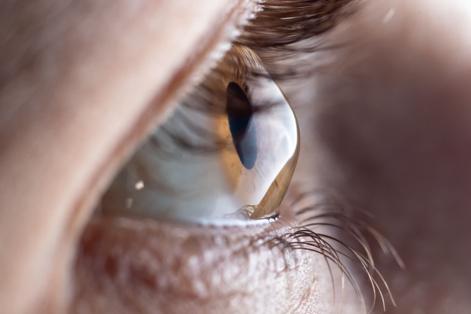 Macro eye photo. Keratoconus - eye disease,