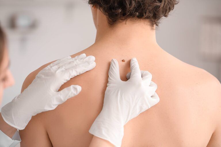 Dermatologist examining mole on young man's back in clinic, closeup