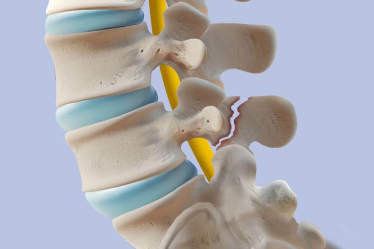 Degenerative Disc Disease