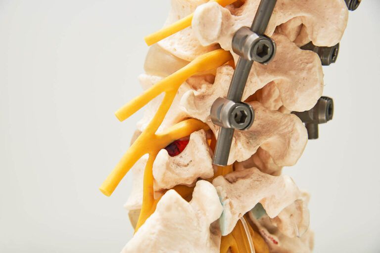 Close-up side view, model of instrument fixation of human lumbar spine model