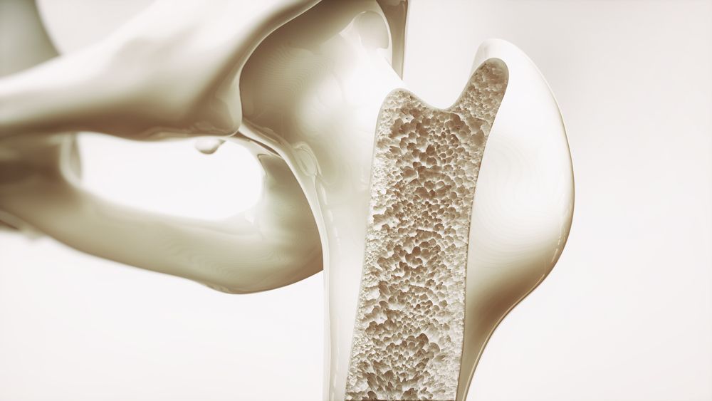Osteoporosis stage 3 of 4 - upper limb bones - 3d rendering