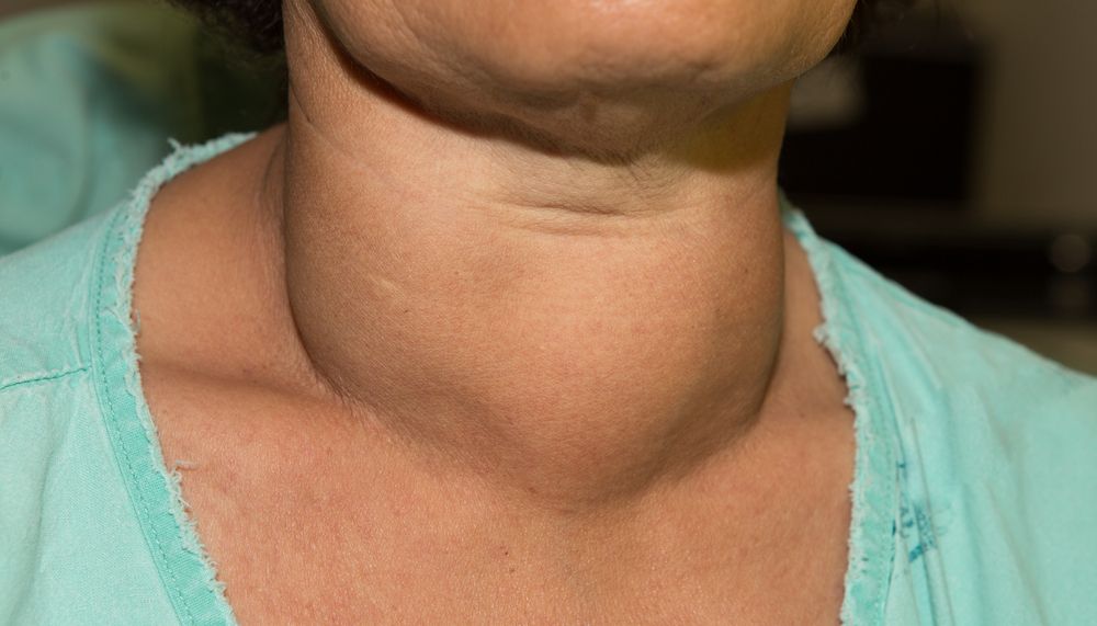 Zooming closeup frontal view of enlarged multinodular thyroid goit