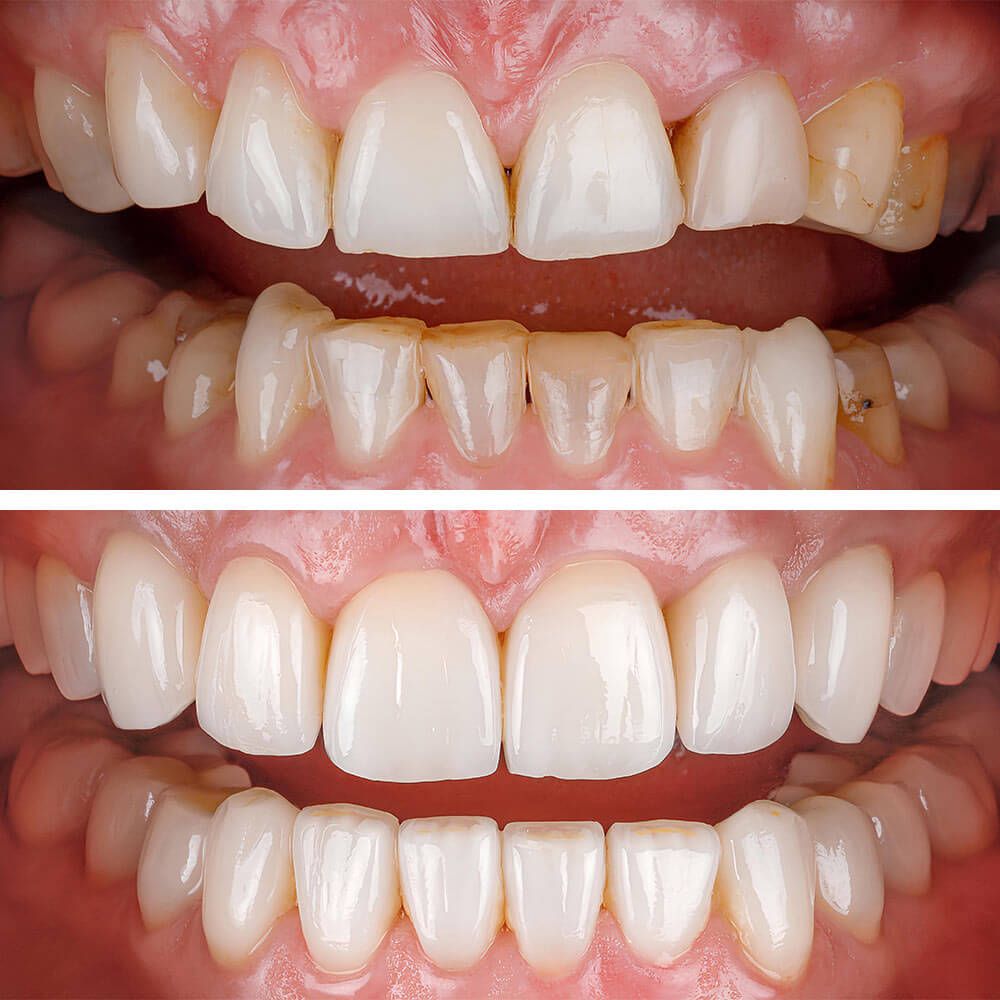 Aesthetic smile design treatment in dental dentistry. E-Max and zirconium porcelain crowns