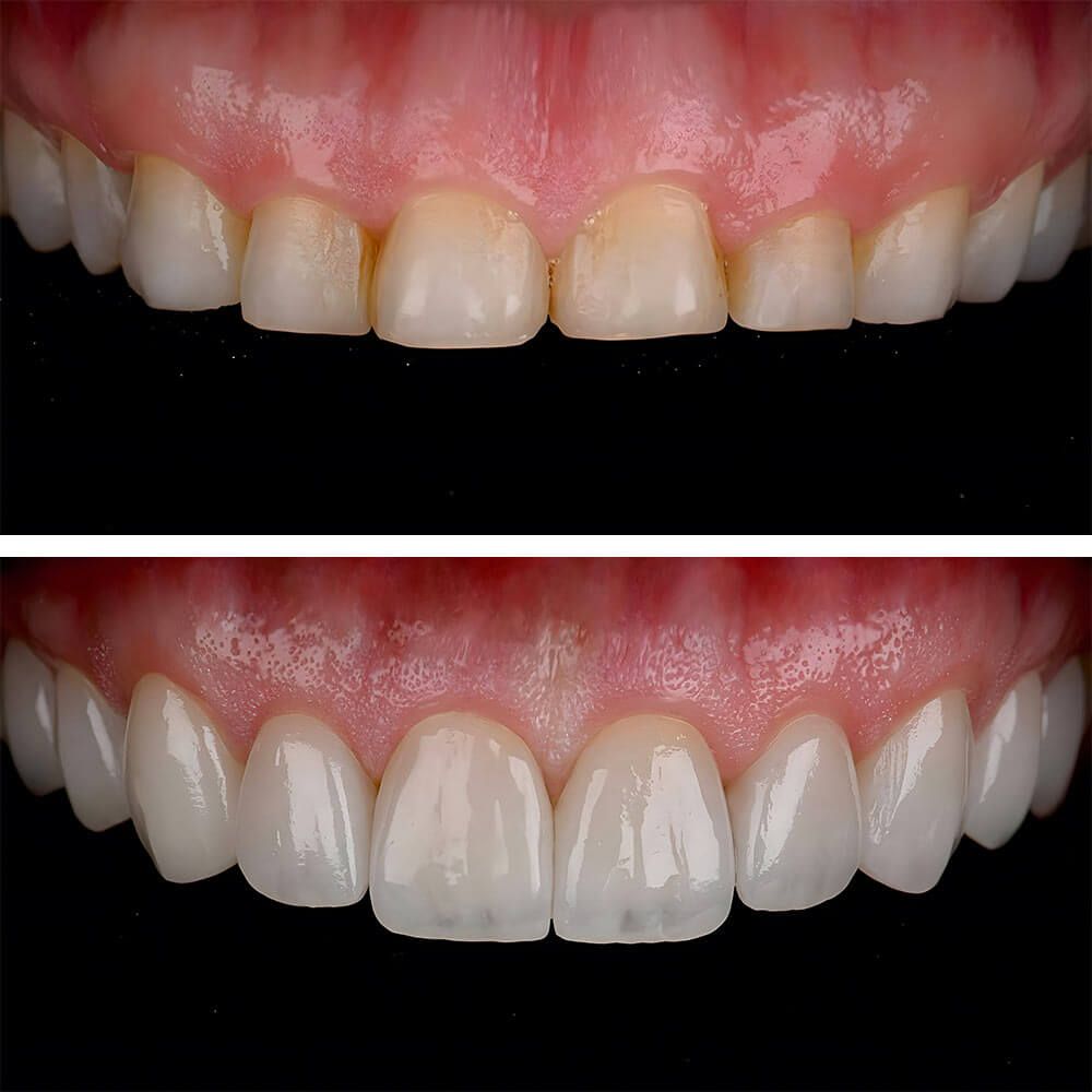 Smile design treatment with laminate veneers, porcelain crowns, and implant supported crowns in dental aesthetic dentistry