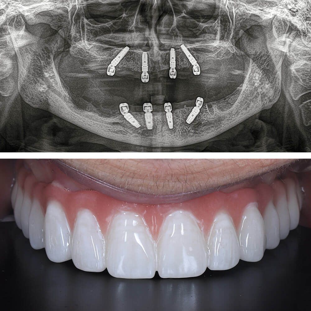 Bone in dental implant treatment in dental oral surgery