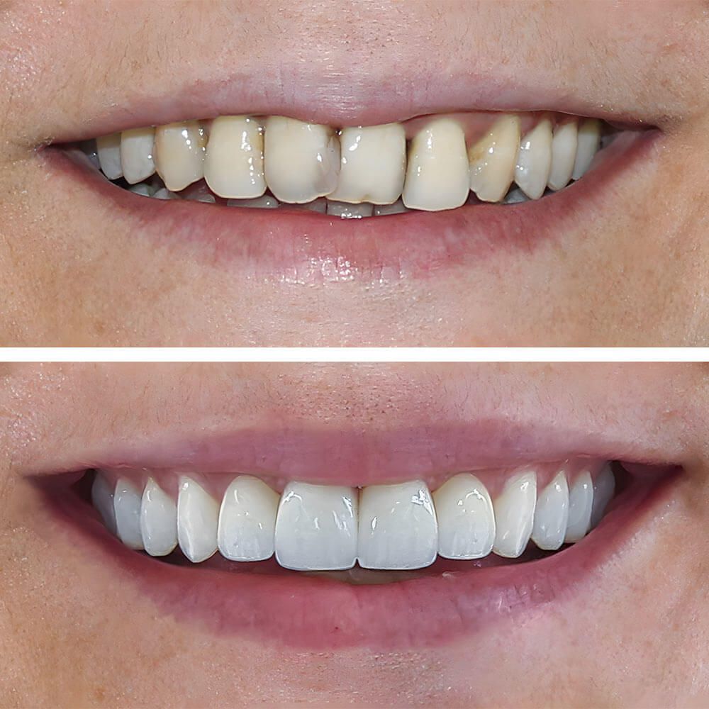 Aesthetic smile design treatment in dental dentistry. Dental treatment with laminate veneers, dental implants, and porcelain crowns