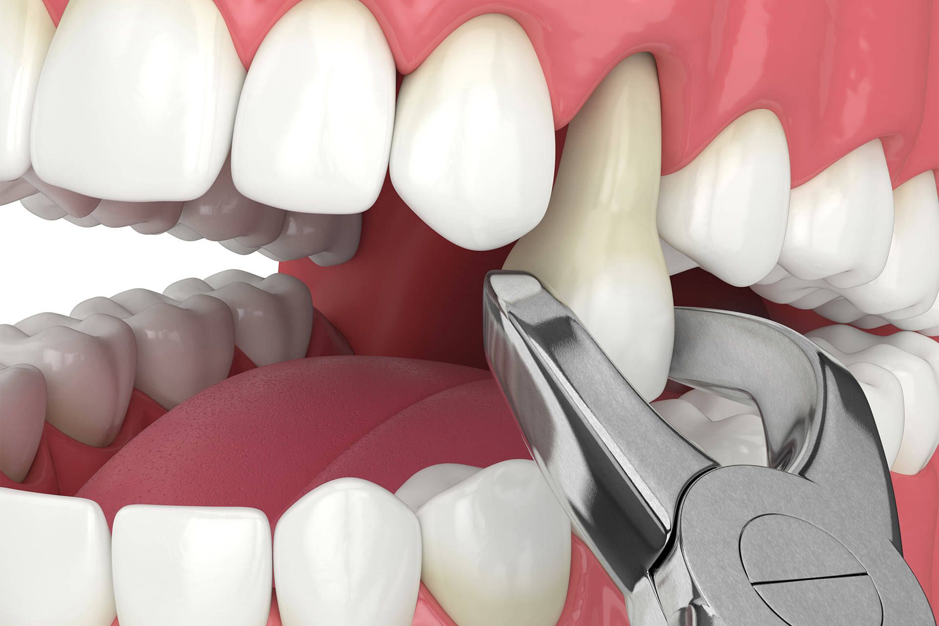 Extractions
