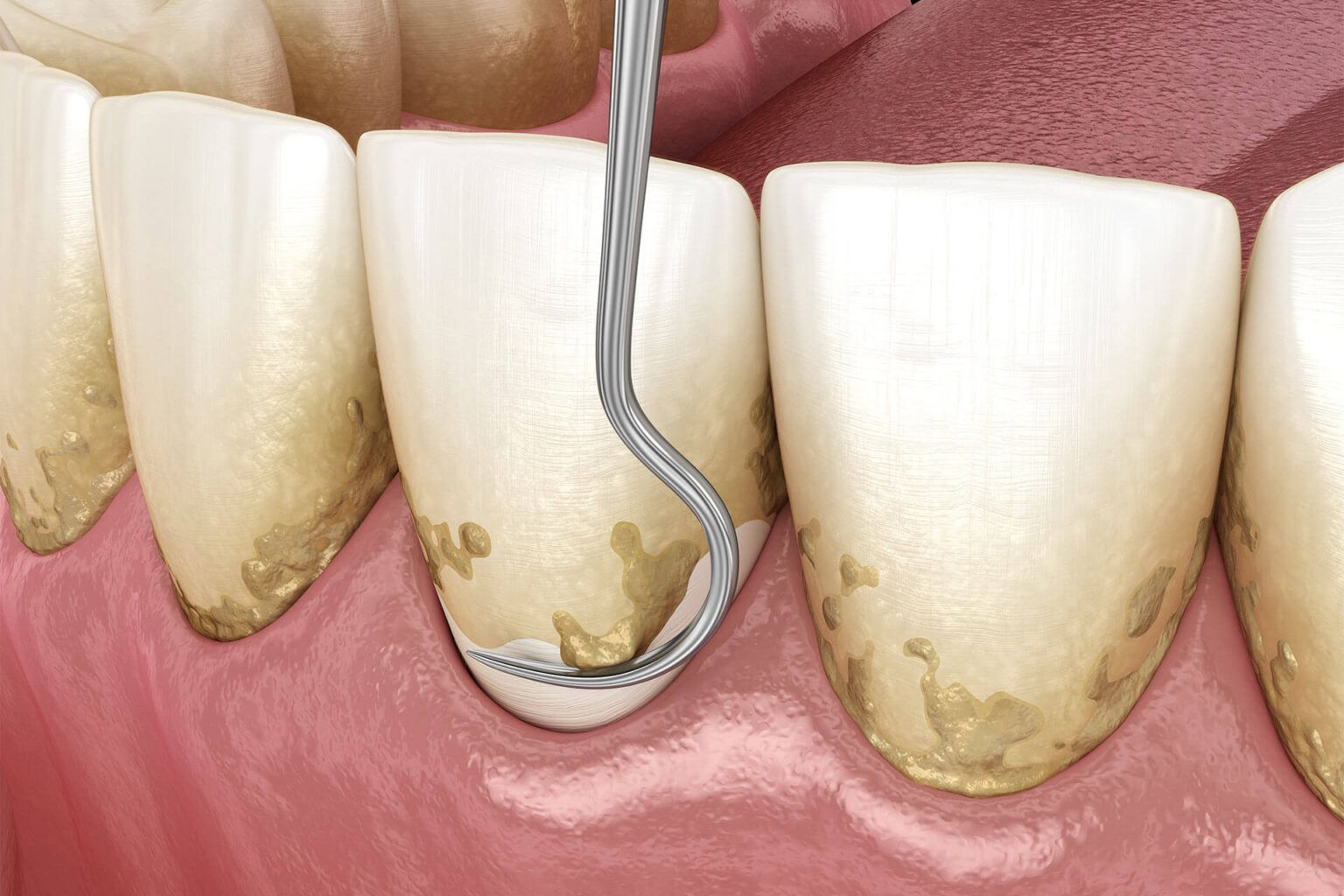 Periodontal Scaling & Root Planing