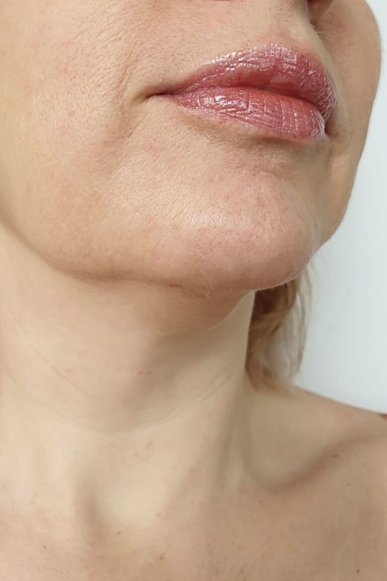 before lip lift