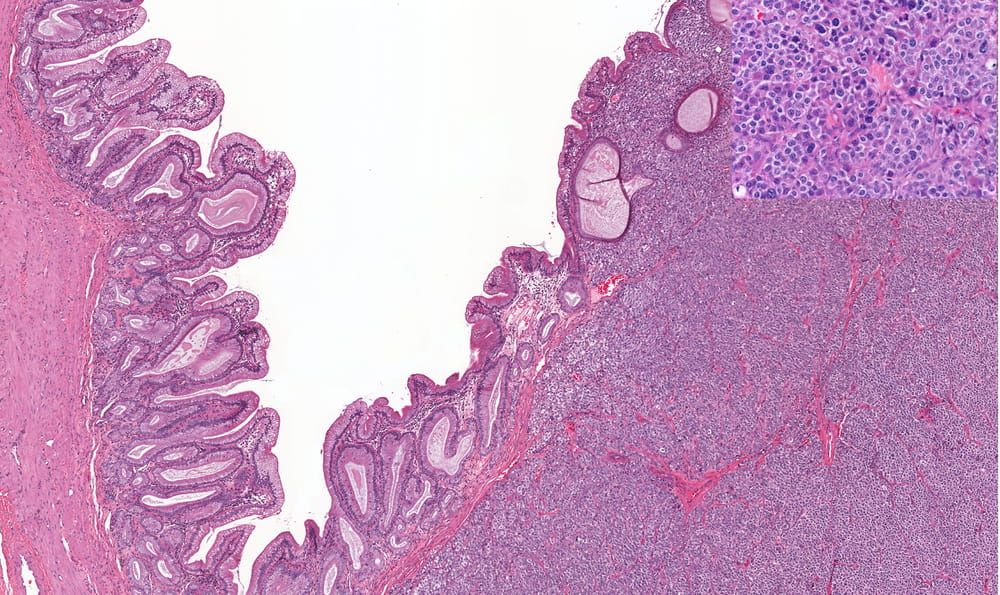 Carcinoid of the gallbladder (right and right bottom) with square box inset showing higher magnification of the cancer cell