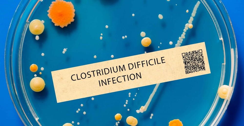 Clostridium difficile infection - Bacterial infection that can cause severe diarrhea and inflammation of the colon.