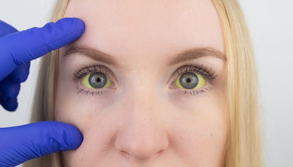 The yellow color of the woman eye. Symptom of jaundice, hepatitis or problems with the gall bladder