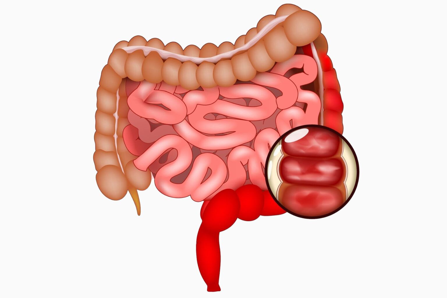 Ulcerative Colitis