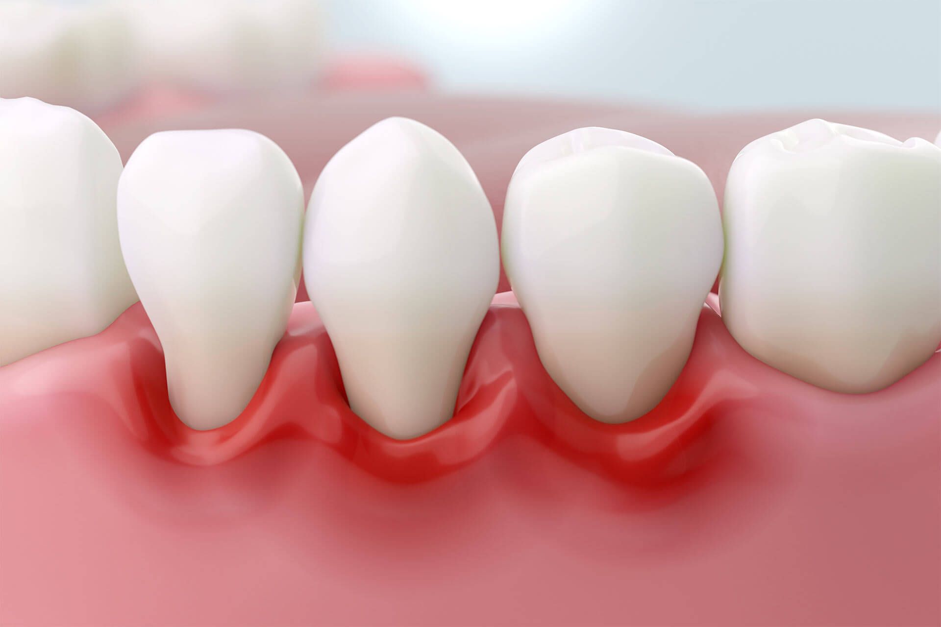 Periodontal disease treatment