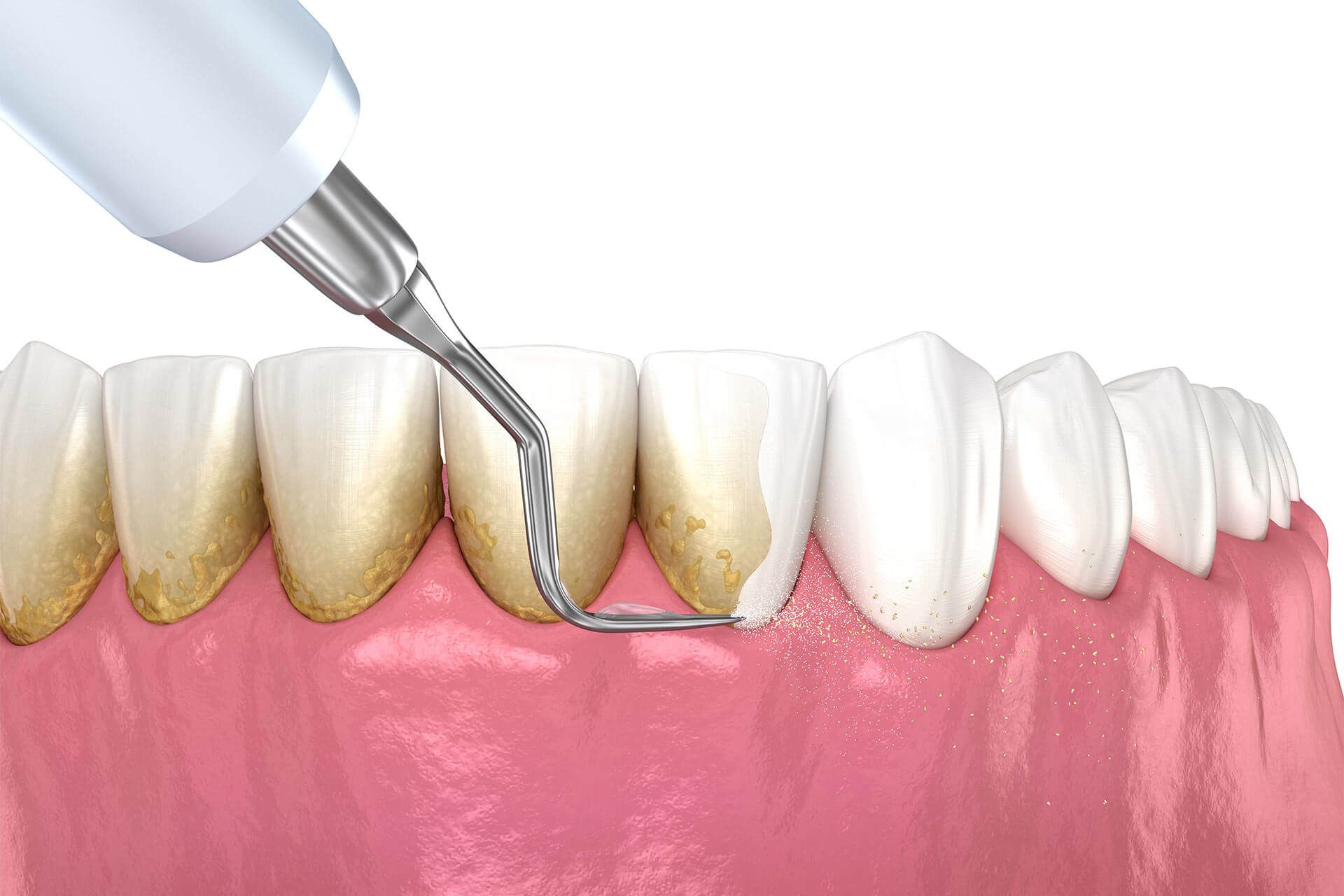 Scaling & Root Planning