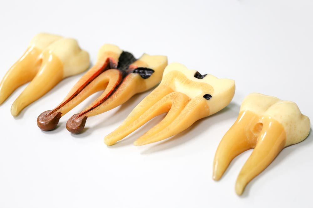 Cavities and Tooth Decay