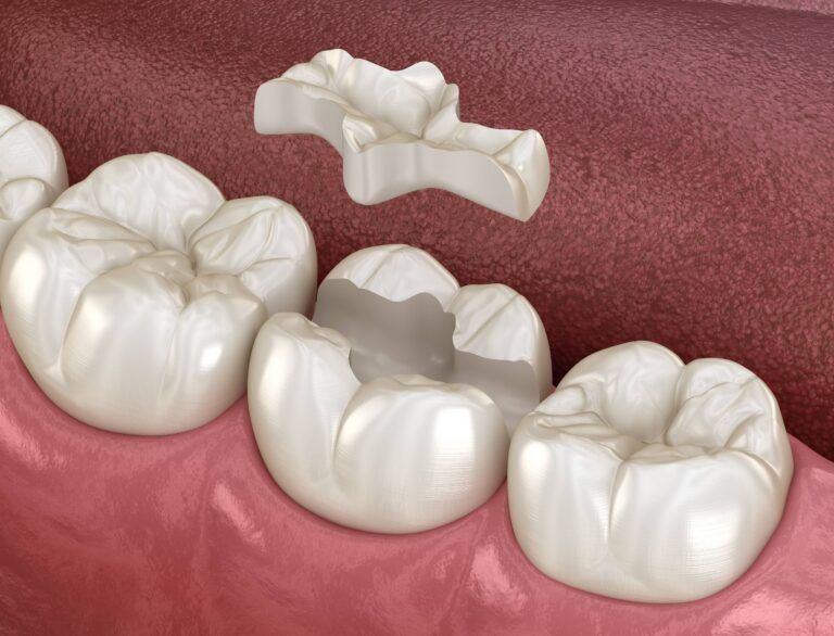 Inlay ceramic crown fixation over tooth. Medically accurate 3D illustration of human teeth treatment