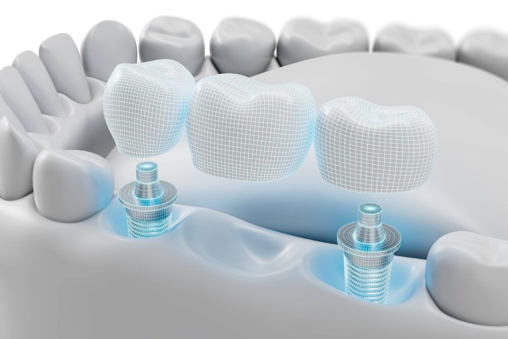 Dental implant bridge structure with 3D modeled artificial teeth and abutments